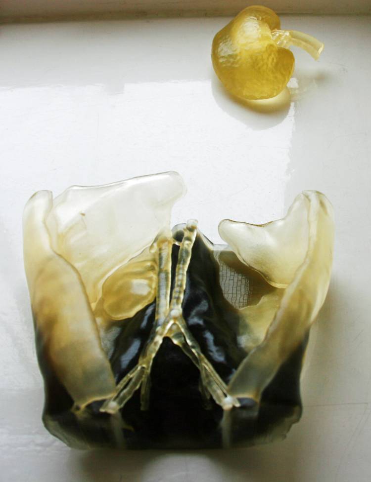 3D printed model of Dexters abdomen next to a 3D model of his fathers kidney enabling surgeons to determine the feasibility of a transplant